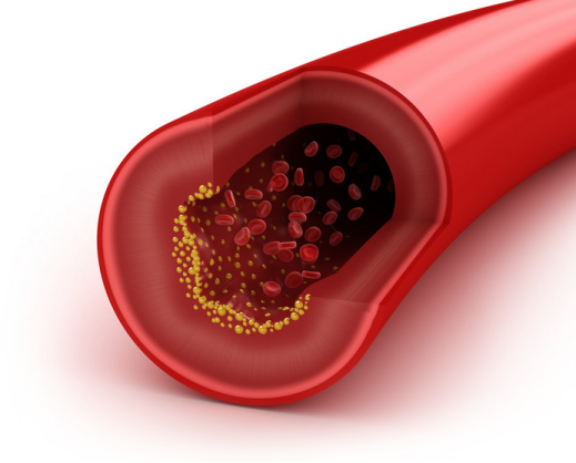 纳豆激酶溶栓速度竟是尿激酶30倍